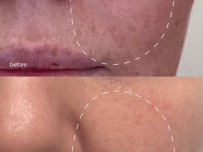 NIEUW: Melanopro Peel System